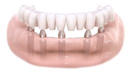 Implantes dentales Madrid