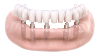 Implantes dentales Madrid