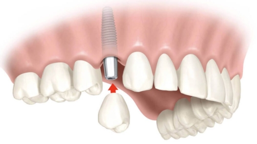 Implantes dentales Madrid