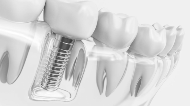 ventajas de los implantes dentales