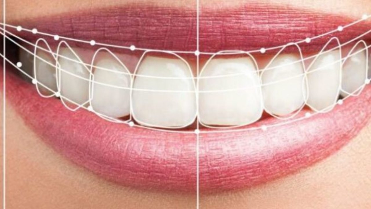 estética implantes dentales