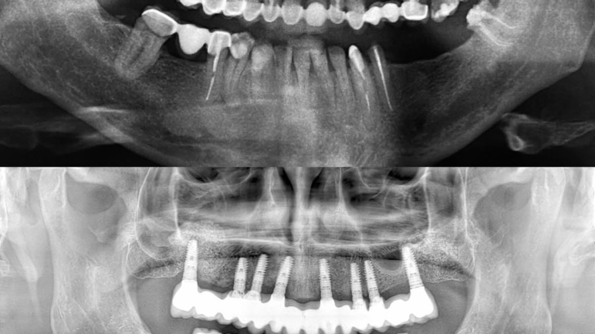 cirugía de implantes dentales