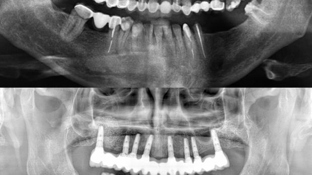 cirugía de implantes dentales