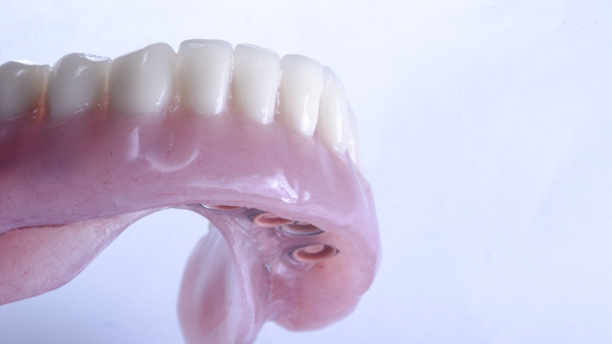 sobredentadura sobre implantes