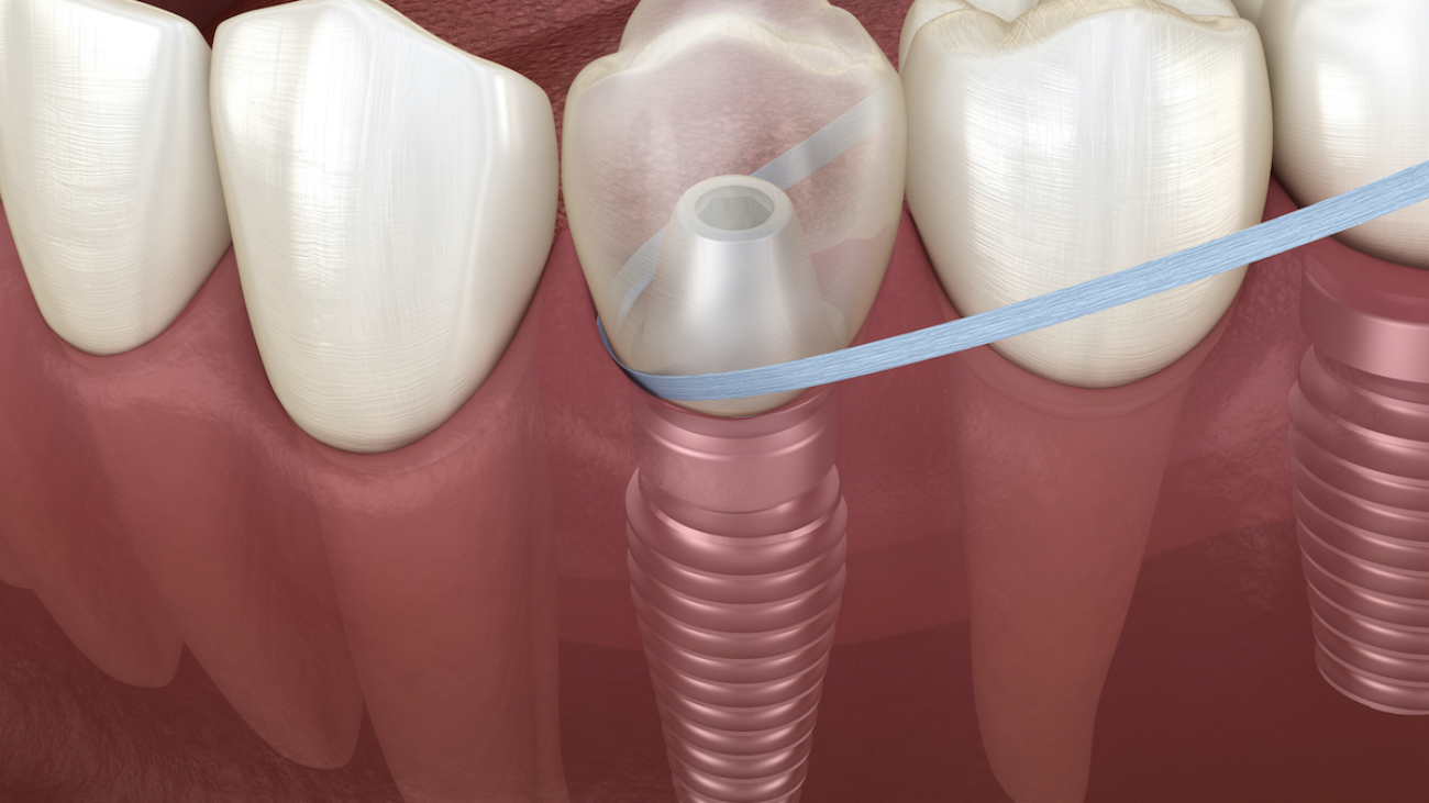 La importancia del uso del hilo dental