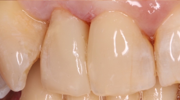 mejorar dientes carillas composite
