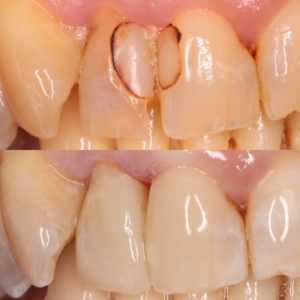 mejorar dientes carillas composite