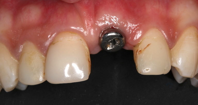 implantes dentales madrid antes