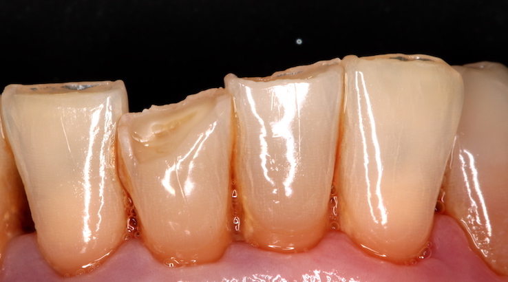 implantes dentales antes