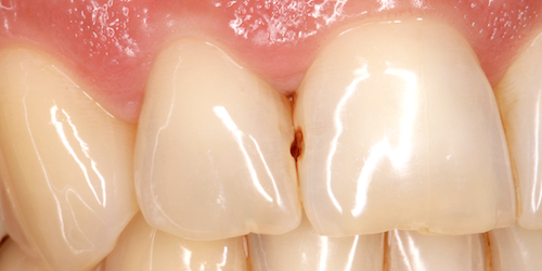 implantes dentales caso a