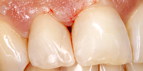 implantes dentales caso b