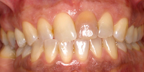 implantes dentales madrid caso 1