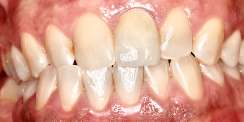 implantes dentales madrid caso 2